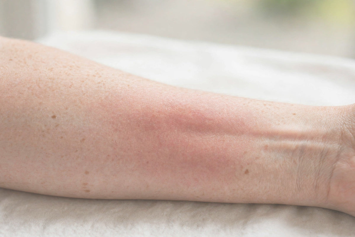 Got Burned? What You Do in the First 20 Minutes Can Make the Difference