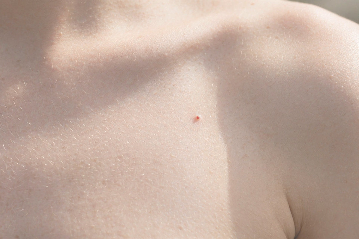 Cherry angioma — small red dot on the skin — close-up — OrOrgani