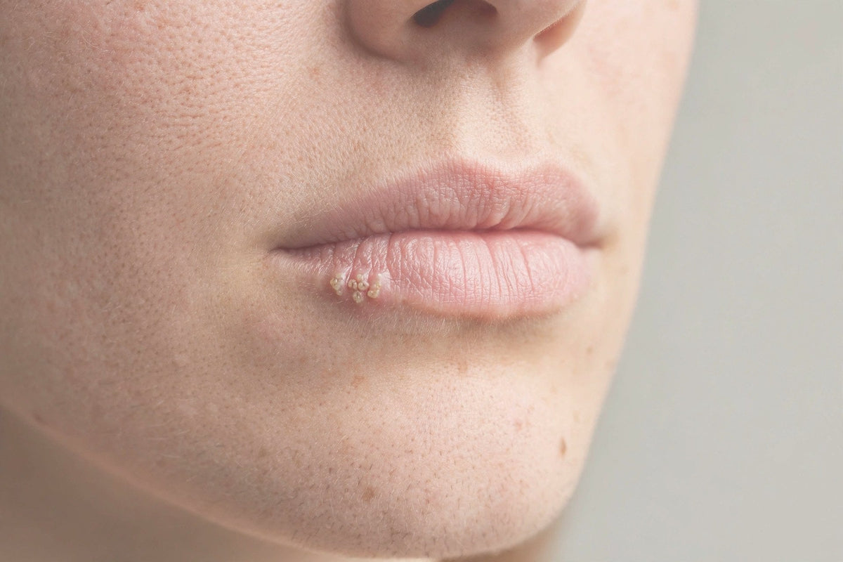 Cold Sores (Herpes) on the Lips and Face – Why They Appear, How to Prevent Them, and What Really Helps?