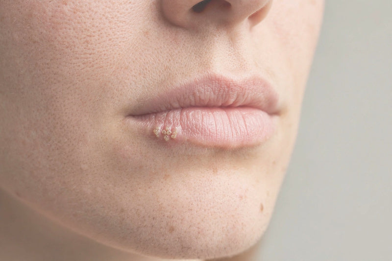 Cold Sores (Herpes) on the Lips and Face – Why They Appear, How to Prevent Them, and What Really Helps?
