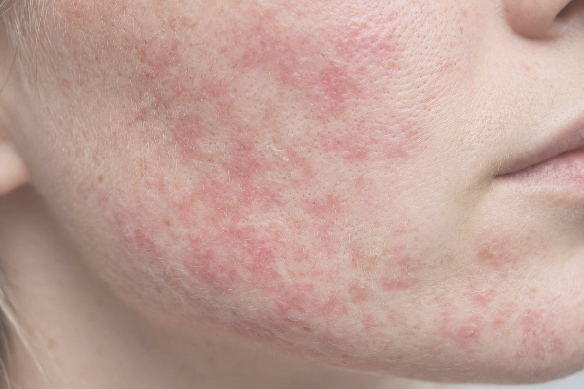 The Cream You've Used for Years Suddenly Burns? Maybe Your Skin Has Developed an Allergy