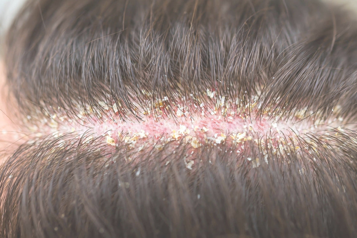 Dandruff on the Scalp – Why It Appears, How to Prevent It, and What Really Helps Get Rid of It?