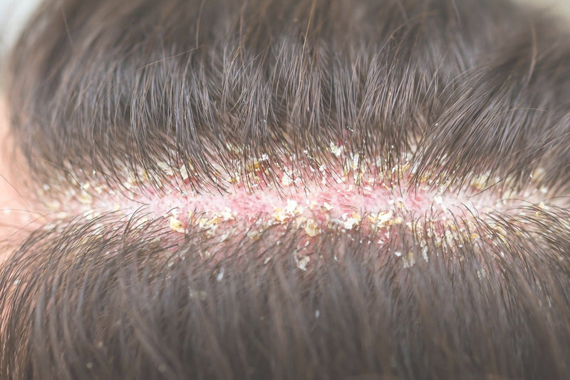 Dandruff on the Scalp – Why It Appears, How to Prevent It, and What Really Helps Get Rid of It?