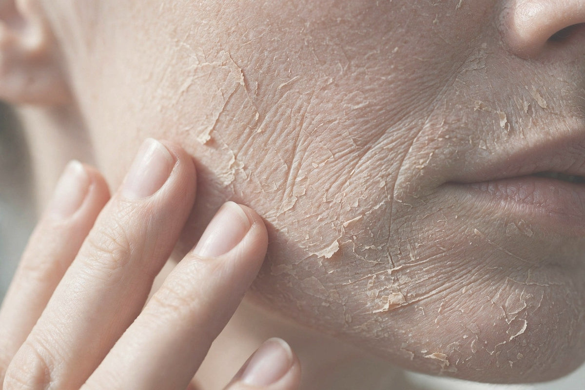 Dry or dehydrated skin — close-up — OrOrgani