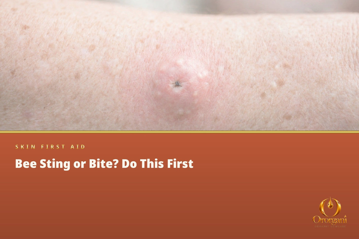 Bee Sting or Spider Bite – What Really Helps and When It Is Dangerous?