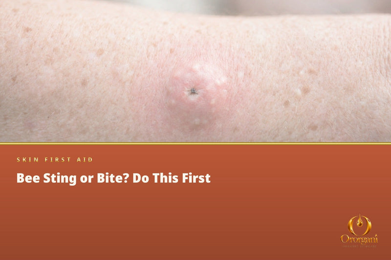 Bee Sting or Spider Bite – What Really Helps and When It Is Dangerous?