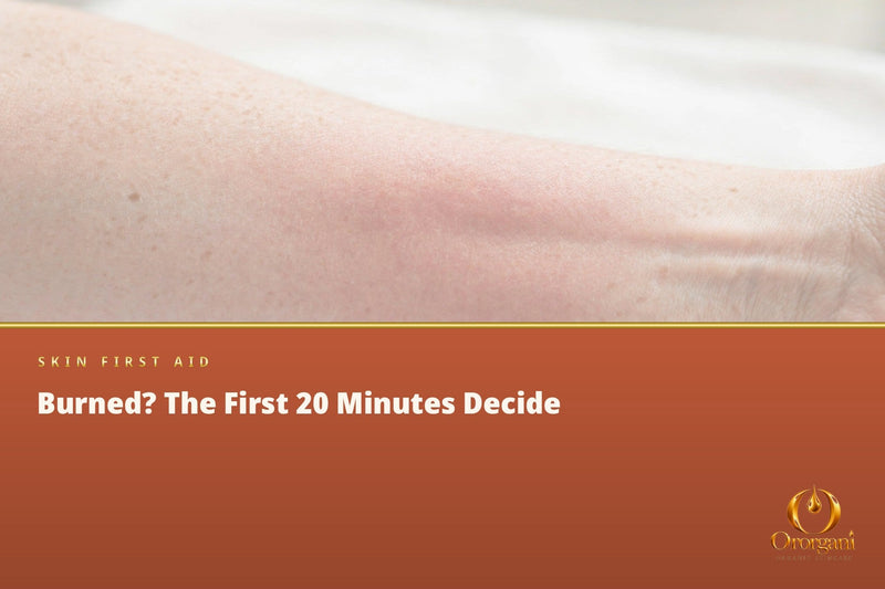 Got Burned? What You Do in the First 20 Minutes Can Make the Difference