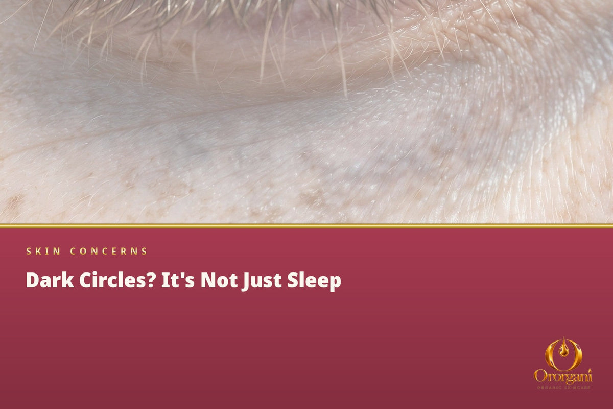 You Slept Eight Hours and Still Have Dark Circles Under Your Eyes?