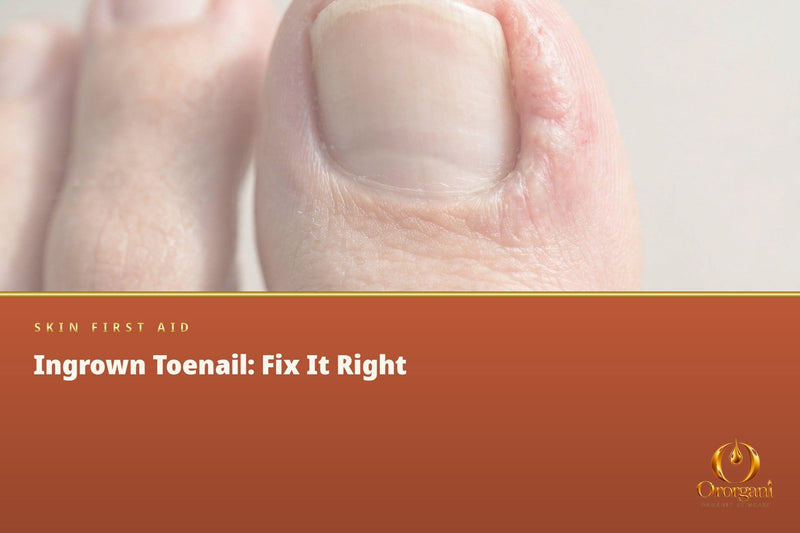 Ingrown Toenail – Why It Happens, How to Treat It, and How to Prevent the Pain