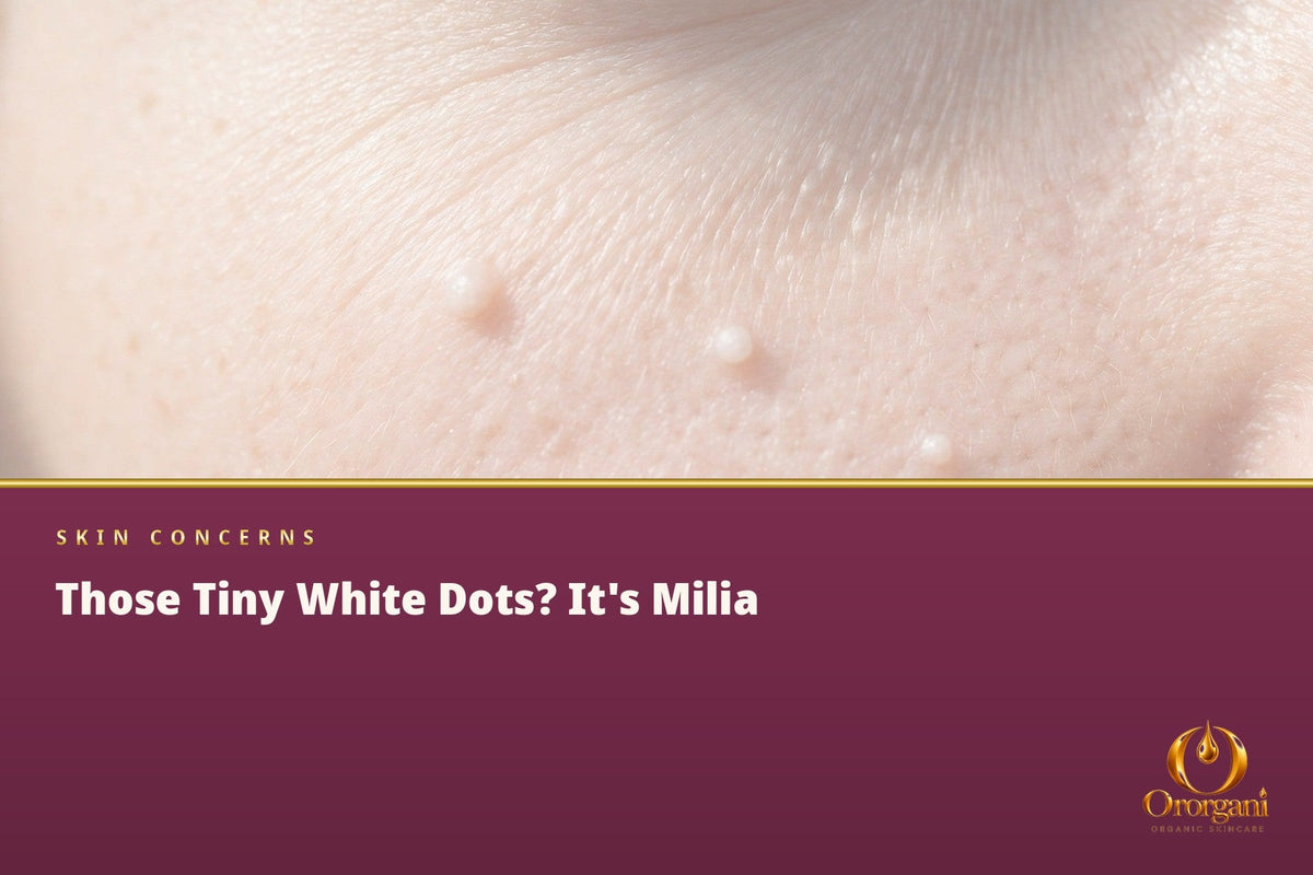 The Tiny White Dots That Won't Disappear from Your Face – What Is Milia and How Is It Treated?