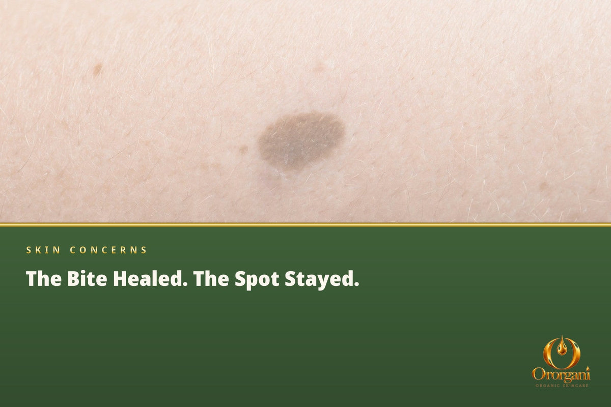 The Bite Is Gone, So Why Does the Spot Remain?