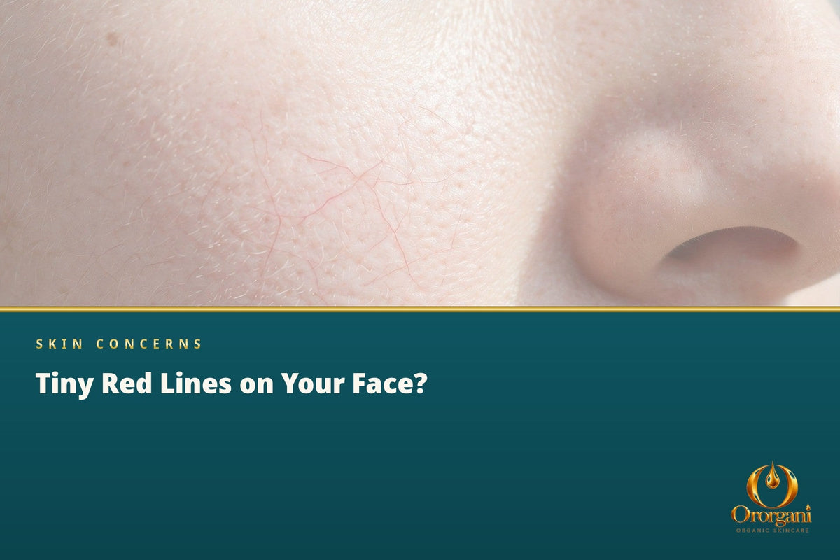 The Small Red Lines That Appear on the Face – and Why Don't They Disappear?