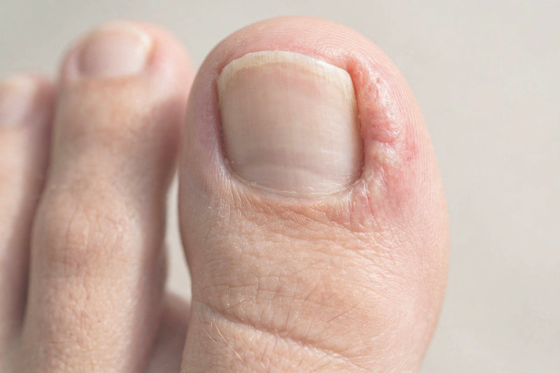 Ingrown Toenail – Why It Happens, How to Treat It, and How to Prevent the Pain