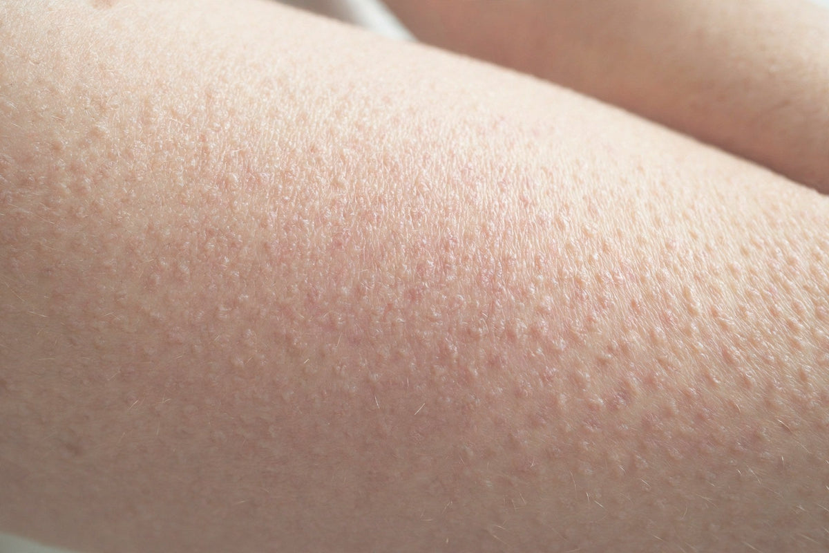 Keratosis pilaris on the upper arm — close-up — OrOrgani