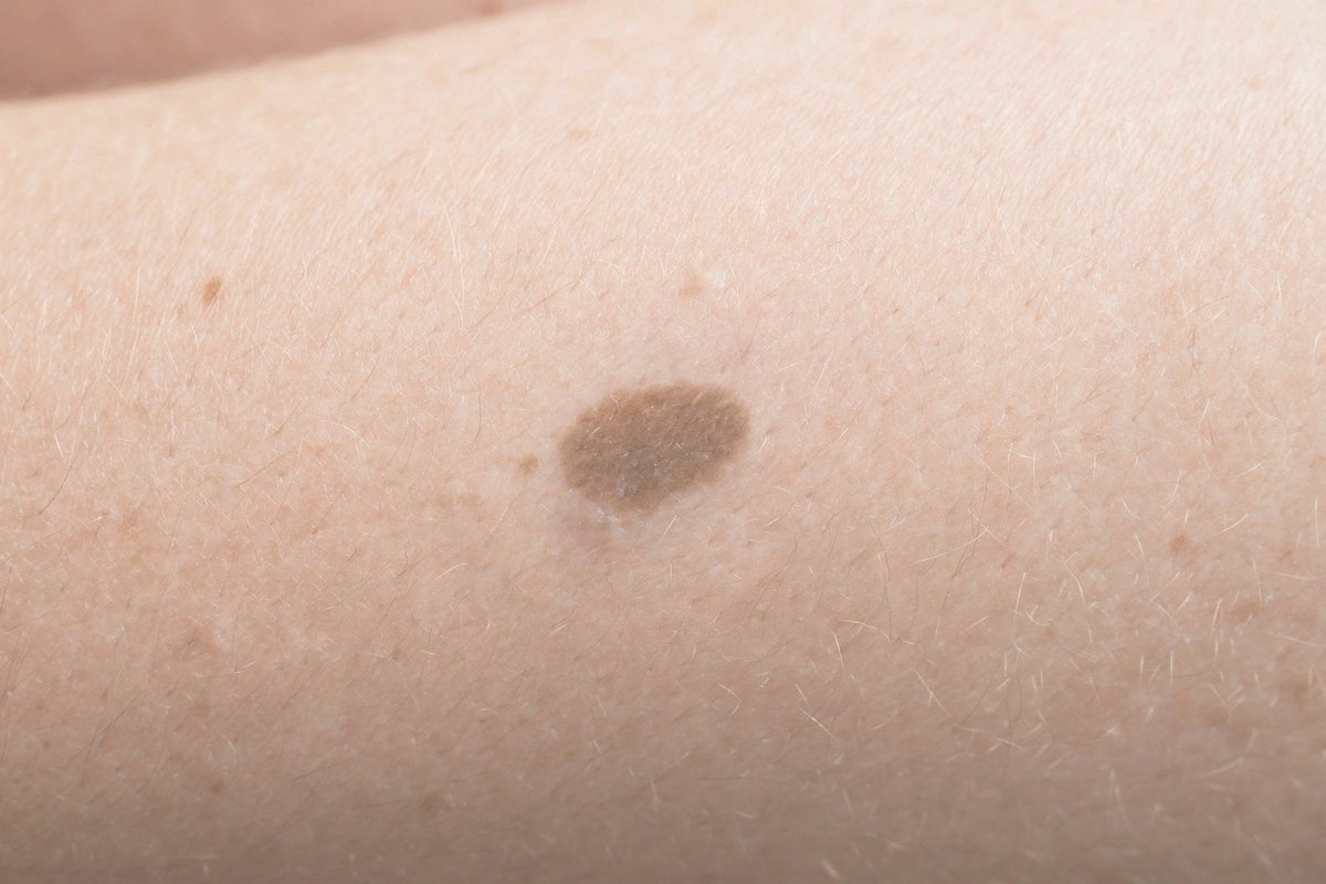 Brown spot remaining after a healed bite — close-up — OrOrgani