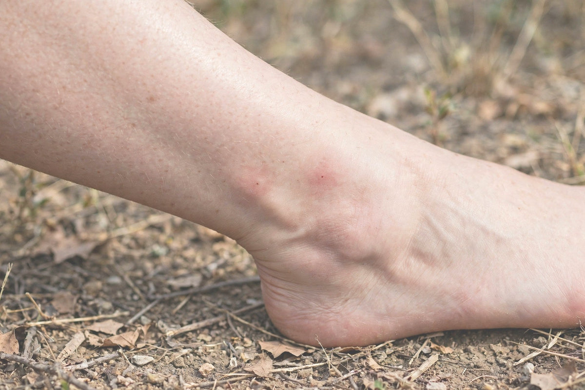 Snake Bite, Scorpion Sting or Animal Bite – The Mistakes Not to Make in the First Moments