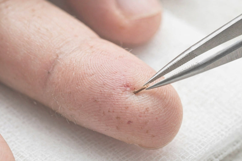 A Splinter in the Skin – How to Remove It Correctly and When It's Better Not to Touch