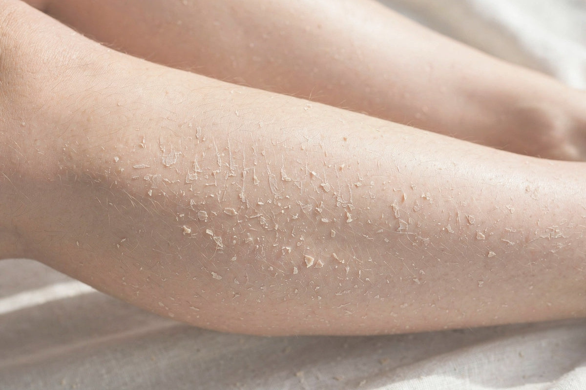 Dry skin on the shin — close-up — OrOrgani